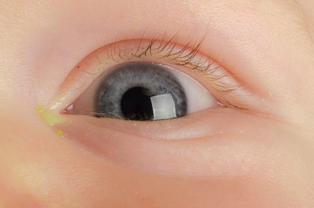 Ropiejące oczy u dziecka są częstym zjawiskiem, które zwykle ustępuje samoistnie. W niektórych sytuacjach objaw ten wymaga jednak wizyty u pediatry.