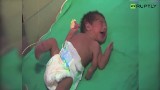 W Indiach urodziło się dziecko z trzema rękami