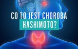 Choroba Hashimoto: czym jest i na czym polega?