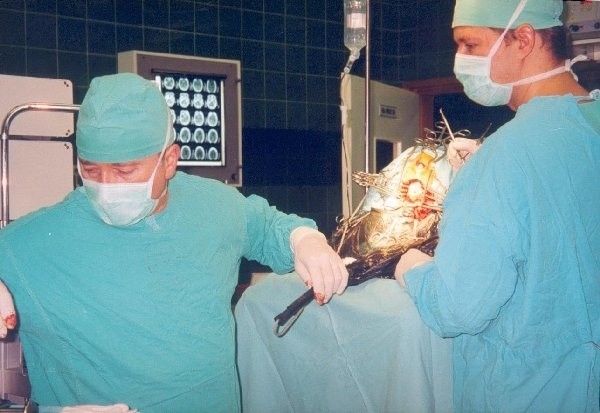 Operuje ordynator neurochirurgii Adam  Zaborowski (z lewej), obok Krzysztof Marciniak.  W głębi na ścianie - tor wizyjny ze zdjęciami,  umożliwający śledzenie prawidłowego przebiegu  operacji.