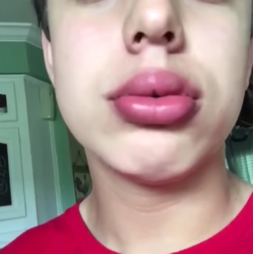 Kylie Jenner Challenge. Ich usta wyglądają okropnie! [zdjęcia]