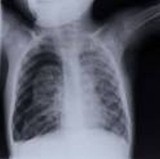 Tomografia płuc i klatki piersiowej w Radomiu. Uwaga, za darmo!