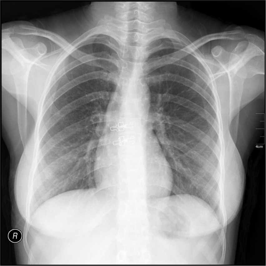 Epidemiolog z Rzeszowa: Zapalenie płuc wciąż bywa chorobą śmiertelną