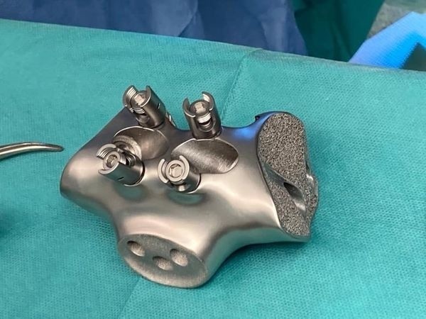 Implant 3D wszczepiony pacjentowi