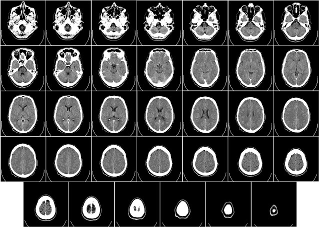 Najczęściej u pacjentów z chorobą Creutzfeldta-Jakoba (ang. Creutzfeldt-Jakob disease, czyli skrót CJD) obraz mózgu w tomografii komputerowej jest prawidłowy.