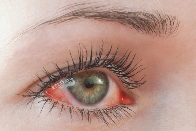 Czerwone oczy najczęściej są wynikiem zmęczenia i niewyspania.