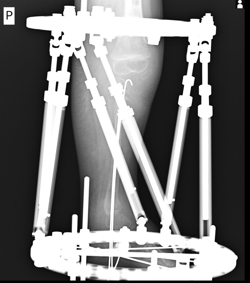 Zdjęcie rentgenowskie przedstawiające nogę dziewczynki po...