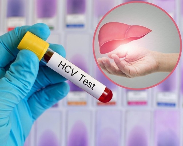 Eksperci szacują, że z HCV żyje w Polsce ponad 100 tysięcy osób, kolejne 500 tysięcy jest zakażonych wirusem HBV.
