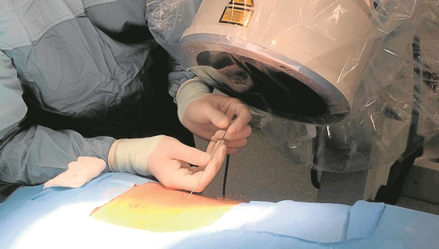Żelowy implant umieszcza się w kręgosłupie chorego za pomocą specjalnej igły.