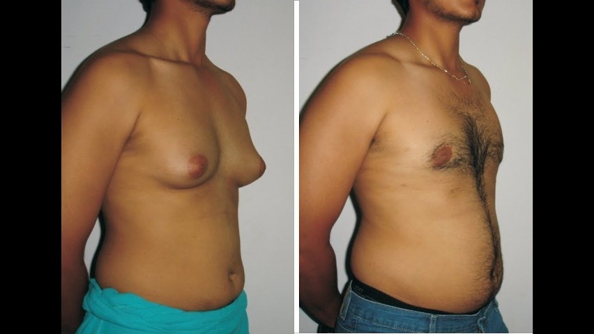 Dlaczego mężczyzniom rosną piersi? Ginekomastia jest objawem chorób. Wielu panów ma piersi większe od kobiet