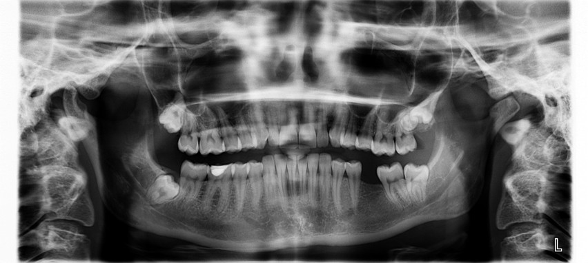 Zgrzytanie zębami może wskazywać na obecność pasożytów w...