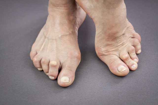 Palce młotkowate to krzywe palce stóp, które są objęte charakterystyczną deformacją