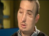 Pacjent po przeszczepie twarzy dochodzi do zdrowia (wideo)