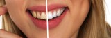 Wybielanie zębów w domu. Sposoby na białe zęby za pomocą pasków wybielających, czarnej pasty do zębów i innych metod