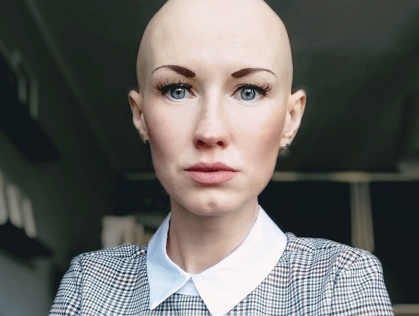 Magdalena Schatt-Skotak cierpi na alopecję, czyli łysienie...