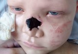 7-letnia Klaudia Witak z Płazy pokonała białaczkę, teraz walczy o rekonstrukcję nosa. Potrzeba 120 tys. zł. Pomożecie? [ZDJĘCIA]