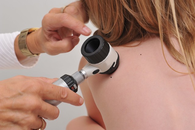 Badania profilaktyczne w przypadku czerniaka to regularne oględziny skóry za pomocą dermatoskopu