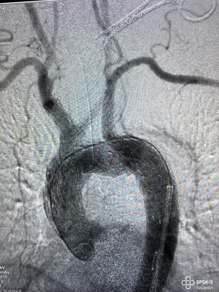 Prawidłowy obraz łuku aorty po wszczepieniu 3-rekawkowego...