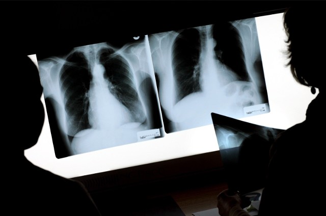 45-letni strażak z Małopolski, którzy przez COVID-19 miał całkowicie zniszczone płuca, dostał szansę na drugie życie. W Śląskim Centrum Chorób Serca w Zabrzu mężczyźnie przeszczepiono oba płuca.
