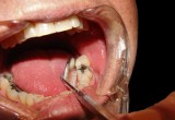 Brak jednego zęba może zaszkodzić!