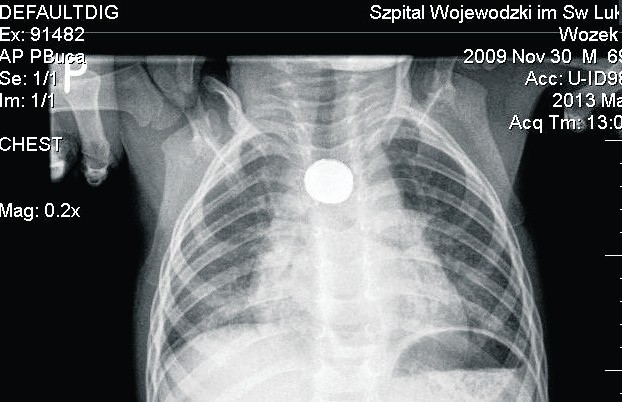 Dopiero rentgen klatki piersiowej pokazał, że chłopiec rzeczywiście połknął baterię. Ta utkwiła w sąsiedztwie aorty.