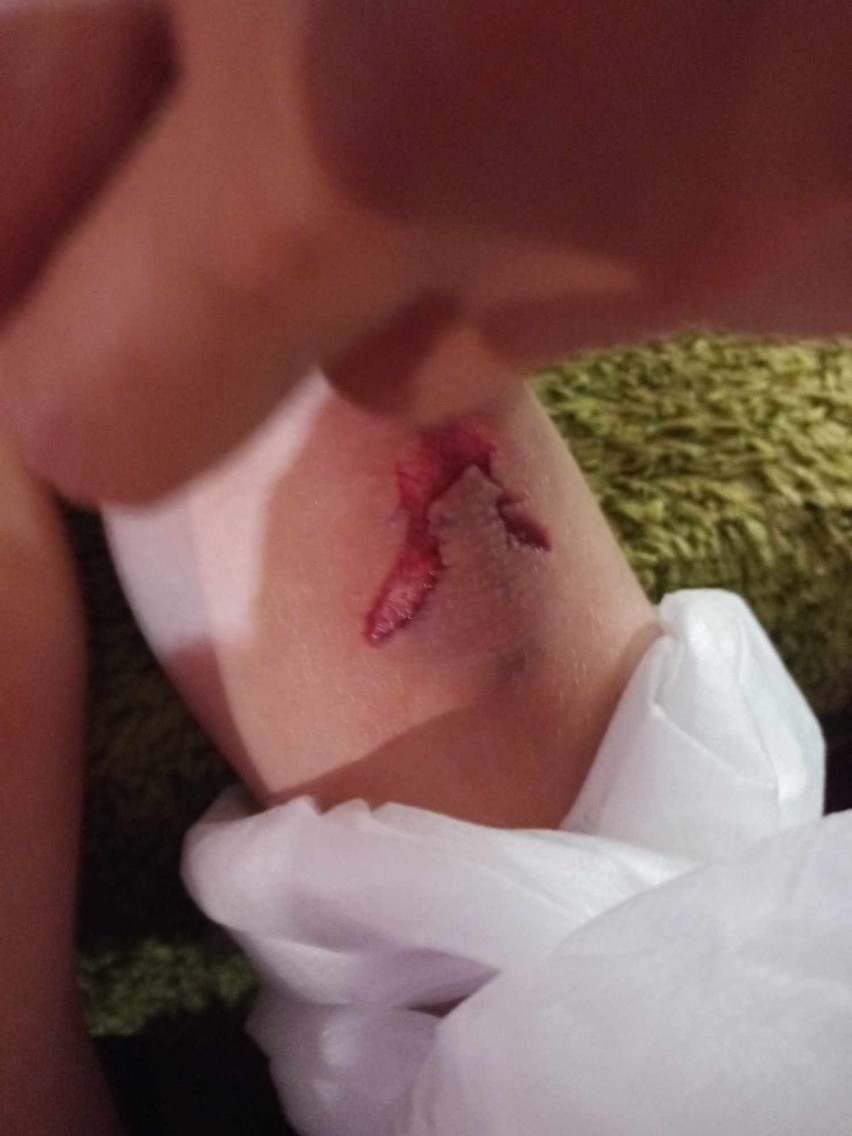 Rana 7-latka po zranieniu w sali zabaw w Tczewie.