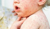 Odra we Wrocławiu. Choruje nieszczepione 14-miesięczne dziecko