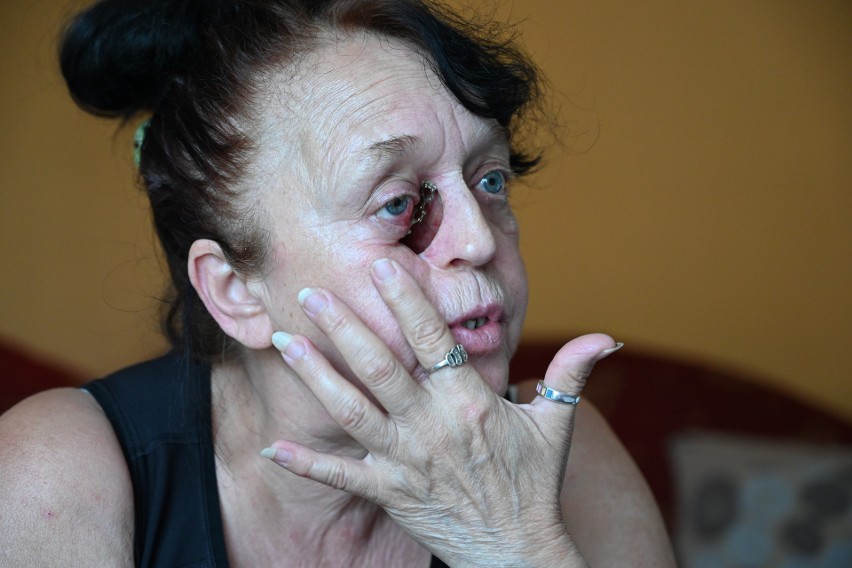 Grażyna Klamka z Siedlec w gminie Chęciny ma oszpeconą twarz po walce z rakiem. Na operację kazano jej czekać...wiele lat! [FILM]