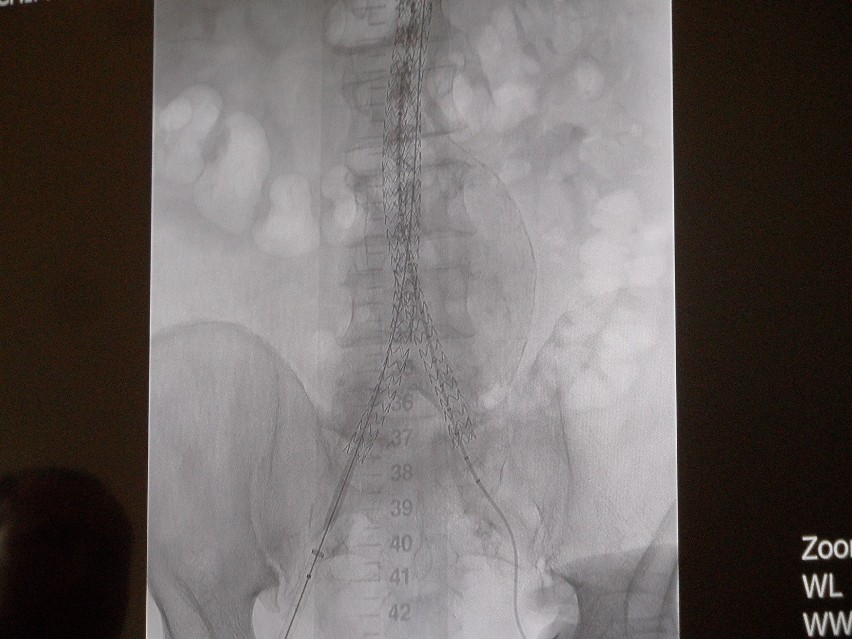Bytom: Chirudzy ze szpitala nr 4 robią nowatorskie operacje tętniaka aorty brzusznej. Ale jak długo?