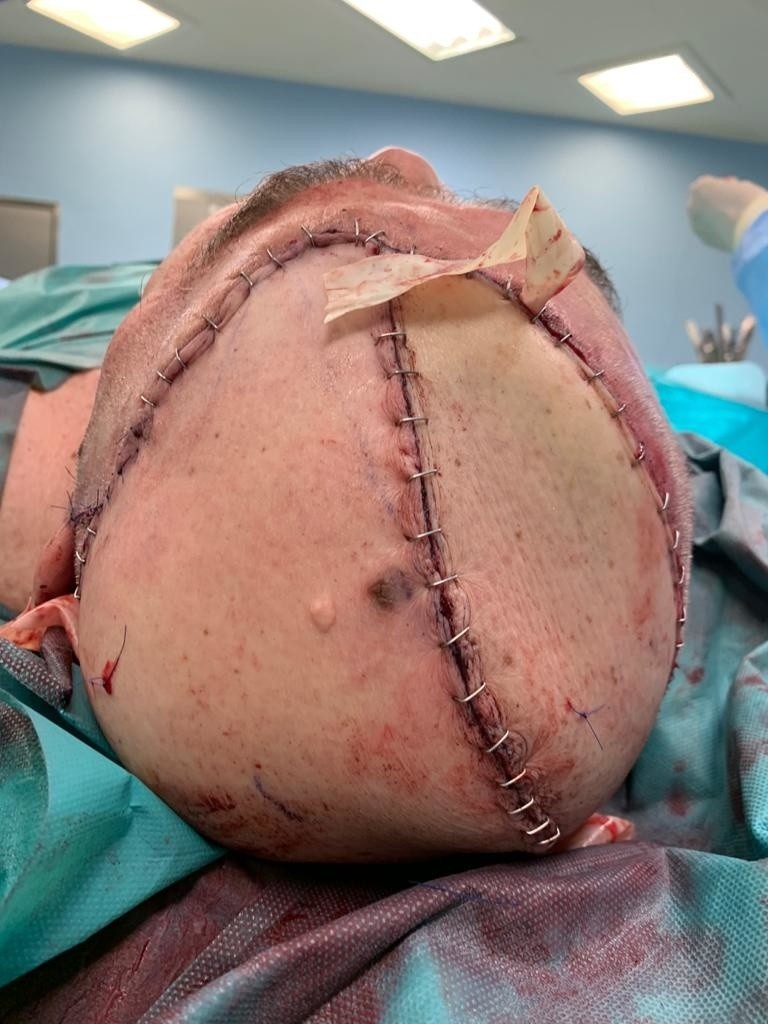 Operacja w Narodowym Instytucie Onkologii: Wycięli nowotwór, a potem pobrali płat z uda, by odtworzyć na jego głowie ubytek skórny