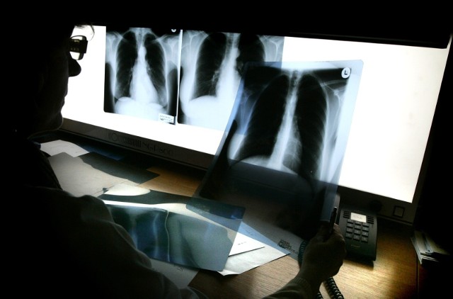W przypadku wykrycia podejrzanej zmiany w obrębie klatki piersiowej należy poszerzyć diagnostykę o tomografię komputerową lub rezonans magnetyczny.