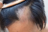 Odkryto nowe przyczyny wypadania włosów. Umożliwi to stworzenie innowacyjnych terapii przeciw łysieniu. Zobacz obiecujące wyniki badań