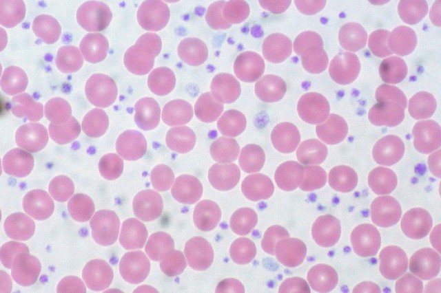 Płytki krwi: obraz krwi peryferyjnej przy trombocytozie, czyli podwyższonej zawartości trombocytów – tutaj rzędu 1,5-2 milliony na mikrolitr, podcza gdy norma wynosi 150-400 tysięcy.