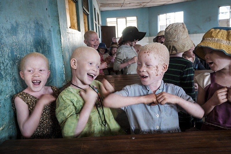 Problem "polowania na albinosów" istnieje naprawdę....