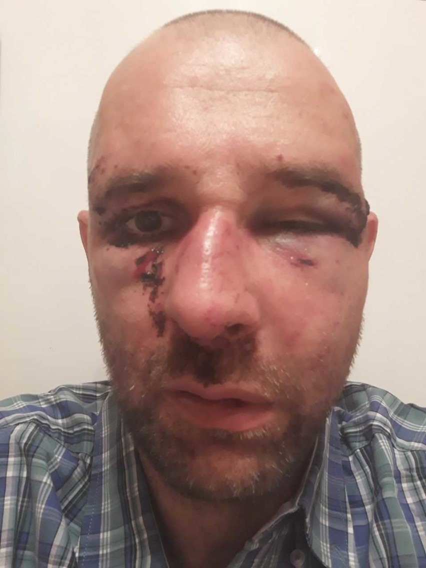 Przemysław Witkowski brutalnie pobity, ma złamany nos. Policja dalej szuka sprawcy i apeluje o pomoc. O które napisy poszło? (ZDJĘCIA)