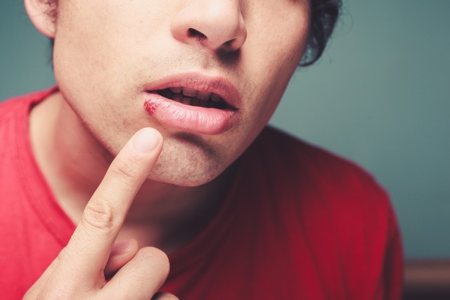 Opryszczka na ustach jest jedną z najpowszechniejszych postaci zakażenia wirusem HSV1 i HSV2.