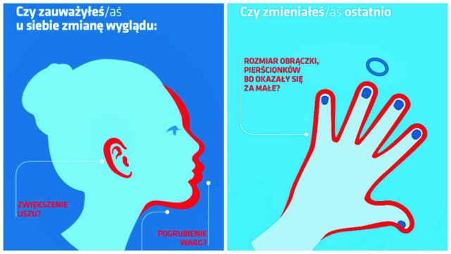 Powiększone dłonie, stopy czy zmienione rysy twarzy to objawy, które mogą świadczyć o akromegalii