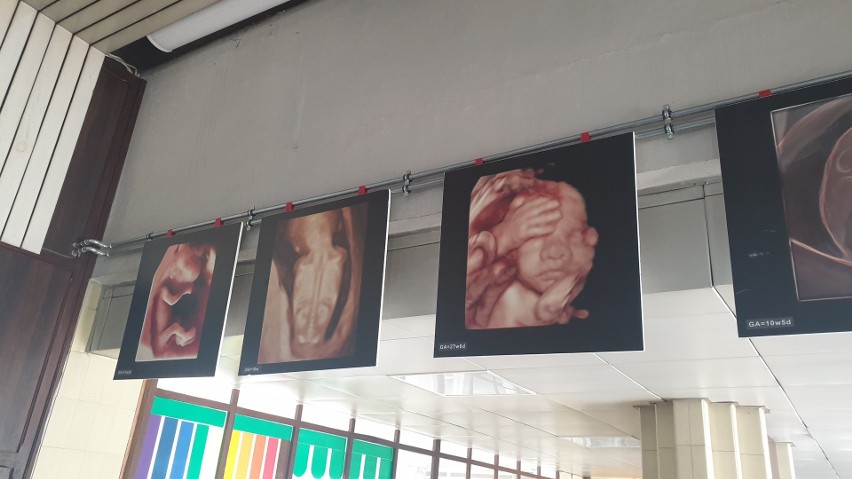 Zdjęcia płodów z USG na nietypowej wystawie fotograficznej w Matce Polce. Robili je lekarze podczas badań prenatalnych 