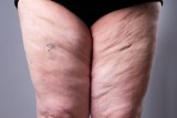 Lipoedema, czyli obrzęk tłuszczowy – tajemnicza „choroba grubych nóg”. Poznaj przyczyny, objawy oraz leczenie obrzęku lipidowego