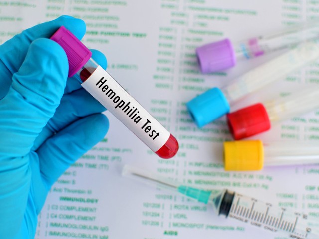 Pełnoobjawowa hemofilia występuje głównie u mężczyzn