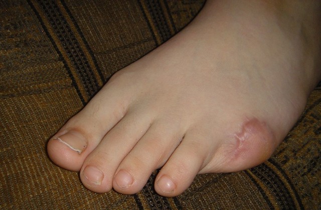 Tak wygląda stopa chłopca po wypadku z ubiegłego roku.