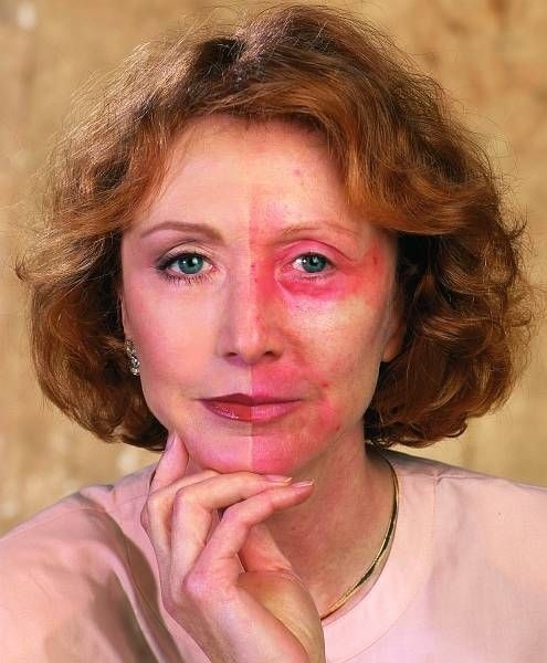 Jane Iredale - po lewej makijaż mineralny, kryjący zaczerwienienia po głębokim laserze; po prawej cera bez retuszu (12 dni po głębokim laserze).