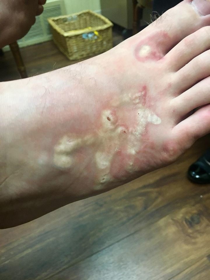 TĘGORYJEC DWUNASTICY - te robaki zainfekowały stopy...