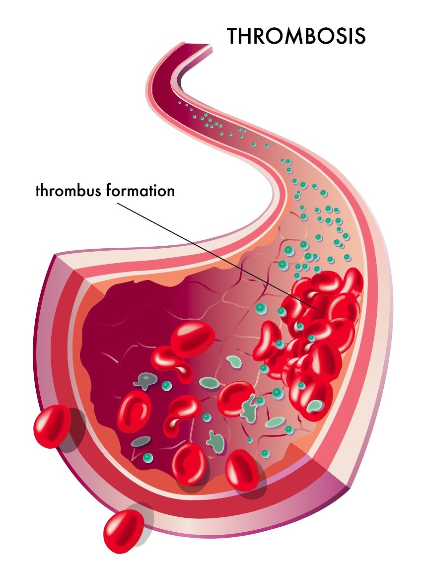 Przyczyną żylnej choroby zakrzepowo-zatorowej jest tworzenie...