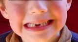 Co zrobić, gdy dziecko wybije sobie ząb?