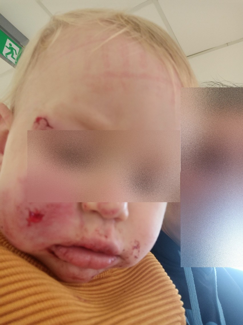 Roczny chłopczyk pogryziony przez dwuletnią dziewczynkę w żłobku w Skarżysku-Kamiennej! Drastyczne zdjęcia 