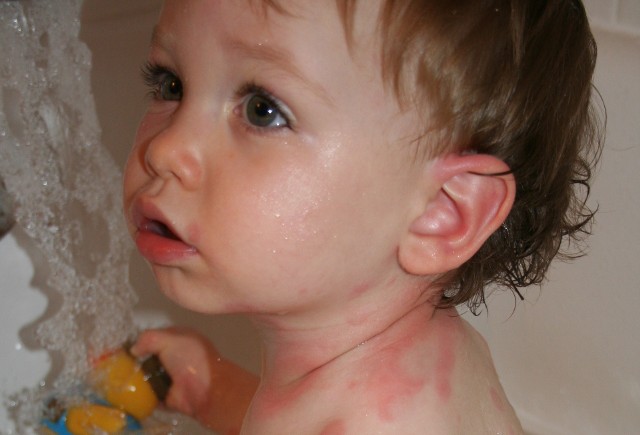 Parwowiroza to choroba, która najczęściej występuje u dzieci. Jednym z jej objawów jest rumień zakaźny.