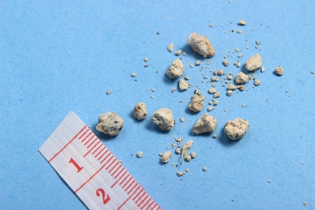 Kamienie nerkowe tworzą się ze osadów powstających w nerkach, a ich wielkość z czasem rośnie. W badaniu USG wykrywane są zwykle te, które mają więcej niż 4 mm średnicy