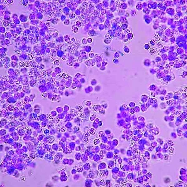 Białe ciałka krwi widoczne pod mikroskopem. Zdrowy człowiek powinien ich mieć przynajmniej 4 tysiące w 1 mm3 krwi.