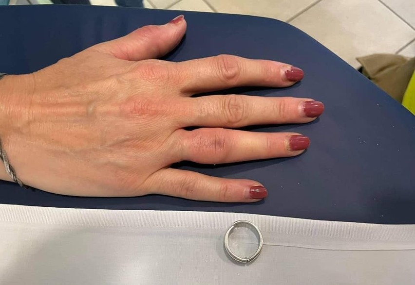 Operacja zdjęcia obrączki z palca kobiety zakończyła się...